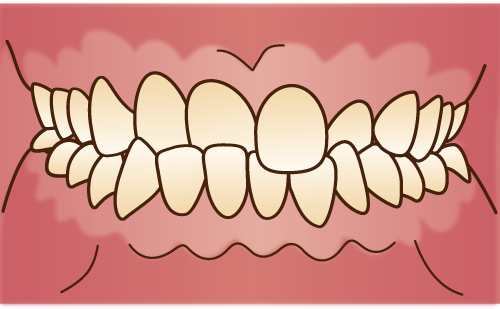 交叉咬合（こうさこうごう）