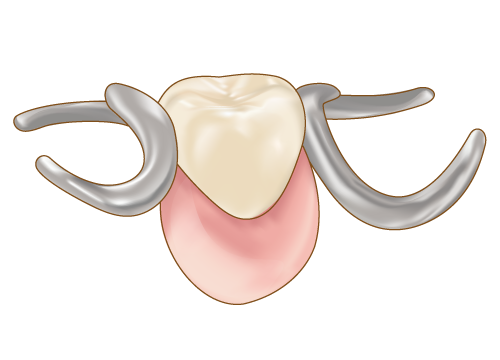 部分入れ歯